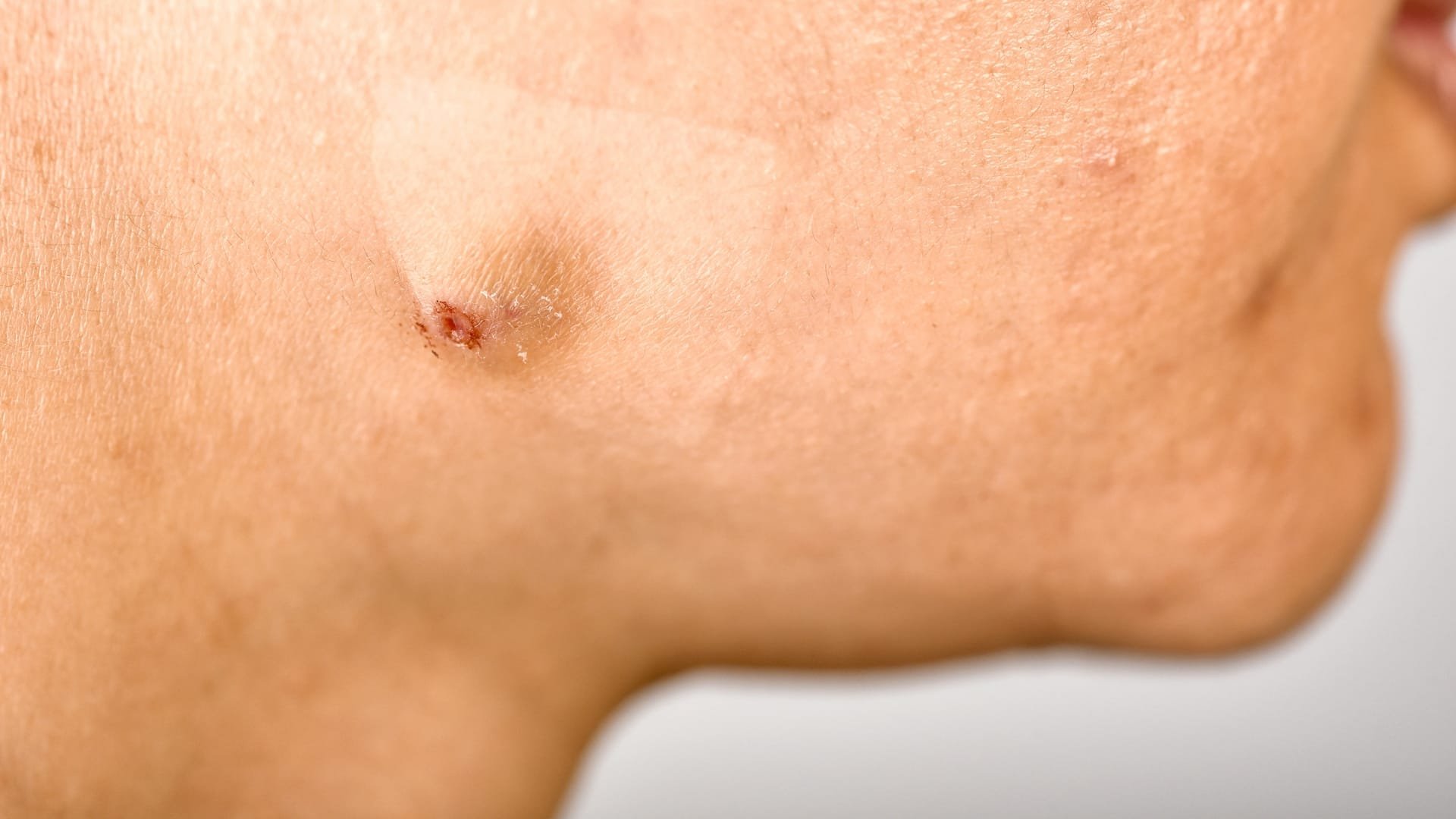 Acne and breakout treatment